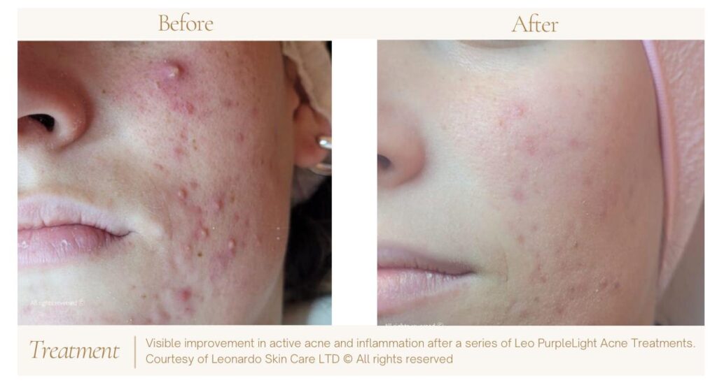 Before and after photo of a Pitshanger Clinic patient who received Leo PurpleLight Acne treatment. The after photo shows fantastic improvements.
