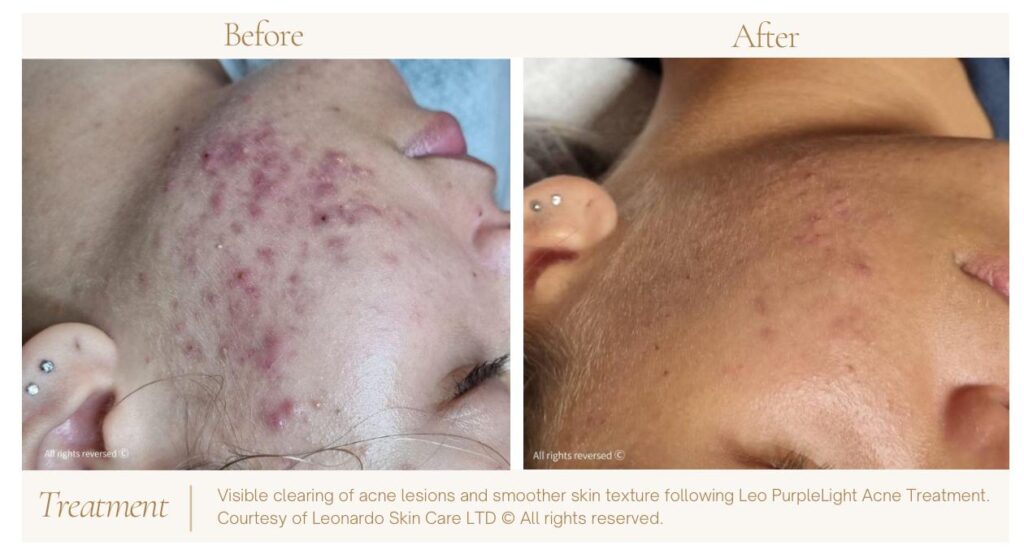 Before and after photo of a patient who received Leo PurpleLight acne treatment, showing fantastic improvements.