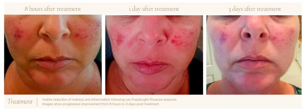 Before and After photo of a patient who received rosacea laser treatment.