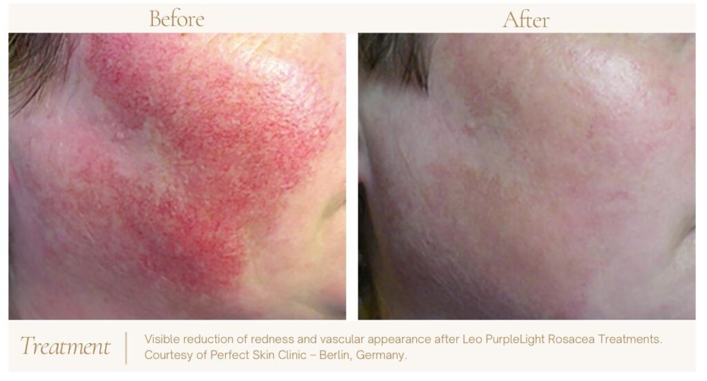 Before and after photo of a patient who received rosacea laser treatment